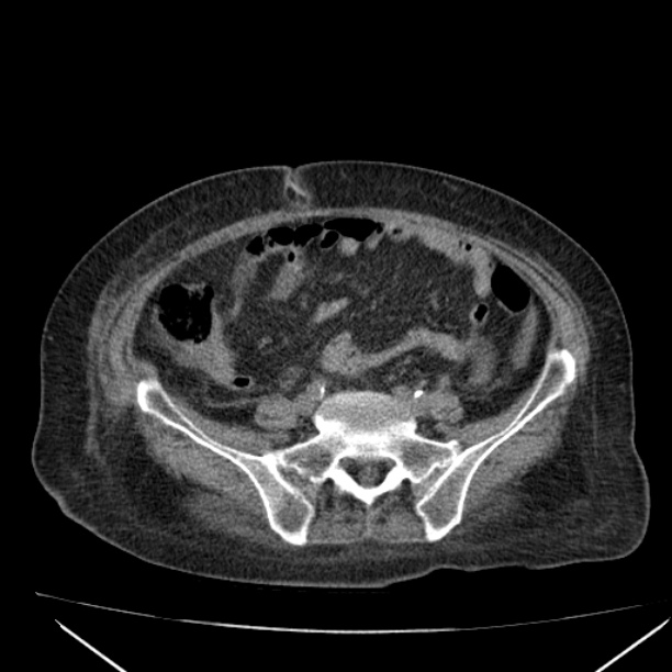 Acute tubular necrosis (Radiopaedia 28077-28334 Axial non-contrast 48).jpg