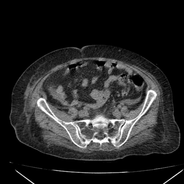 Acute tubular necrosis (Radiopaedia 28077-28334 Axial non-contrast 51).jpg