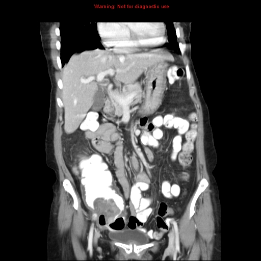 File:Adenocarcinoma of the colon (Radiopaedia 8191-9039 Coronal liver window 17).jpg