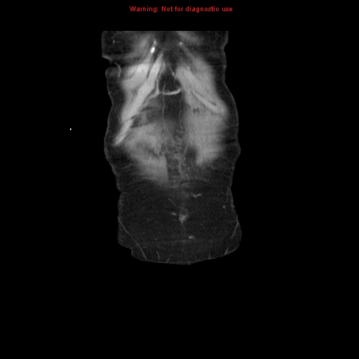 File:Adenocarcinoma of the colon (Radiopaedia 8191-9039 Coronal liver window 4).jpg