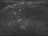 Adenocarcioma of rectum- T1 lesion (Radiopaedia 36921-38546 Axial DWI 66).png