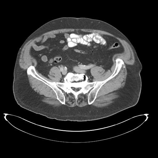Adenocarcioma of rectum- T1 lesion (Radiopaedia 36921-38547 Axial C+ portal venous phase 64).png