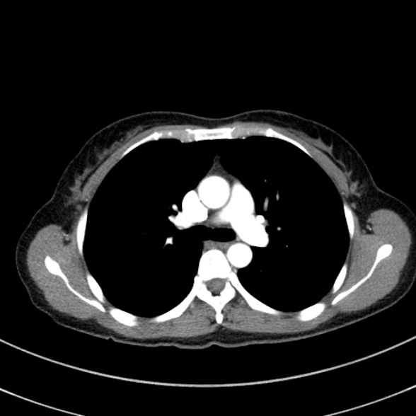 Adenocystic carcinoma of the trachea (Radiopaedia 47677-52525 Axial C+ arterial phase 47).jpg