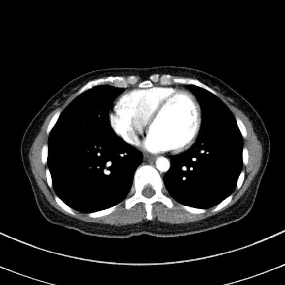 Adenocystic carcinoma of the trachea (Radiopaedia 47677-52525 Axial C+ arterial phase 62).jpg