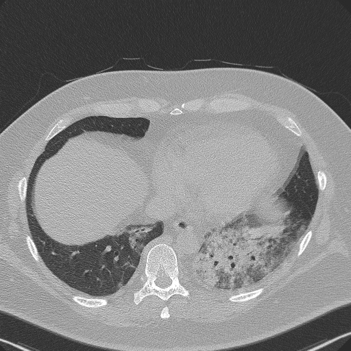 File:Adenoid cystic carcinoma of the trachea (Radiopaedia 49042-54137 Axial lung window 263).jpg