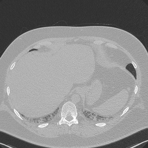 Adenoid cystic carcinoma of the trachea (Radiopaedia 49042-54137 Axial lung window 300).jpg