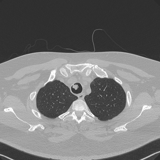 Adenoid cystic carcinoma of the trachea (Radiopaedia 49042-54137 Axial lung window 57).jpg