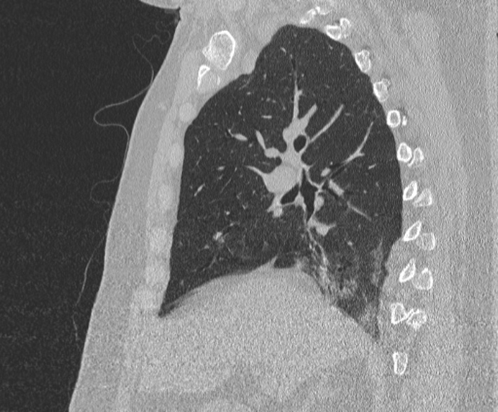 Adenoid cystic carcinoma of the trachea (Radiopaedia 49042-54137 Sagittal lung window 187).jpg