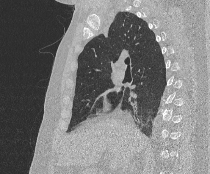 Adenoid cystic carcinoma of the trachea (Radiopaedia 49042-54137 Sagittal lung window 194).jpg
