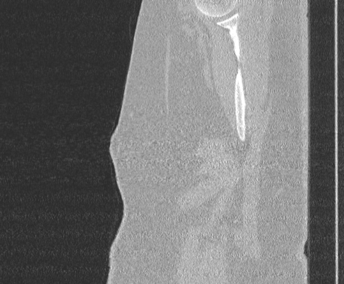 File:Adenoid cystic carcinoma of the trachea (Radiopaedia 49042-54137 Sagittal lung window 4).jpg