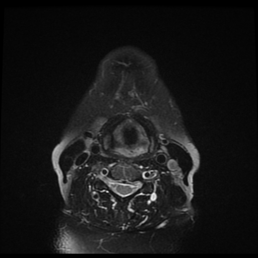 File:Adenoid cystic tumor of palate (Radiopaedia 46980-51519 Axial T2 fat sat 8).png