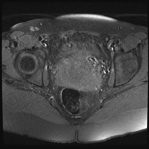 File:Adenomyosis-scar endometriosis (Radiopaedia 65863-75022 Axial T1 fat sat 18).jpg