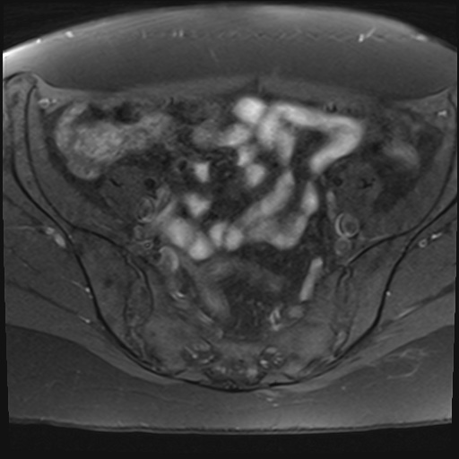 File:Adenomyosis and endometriotic cysts (Radiopaedia 82300-96367 Axial T1 fat sat 24).jpg