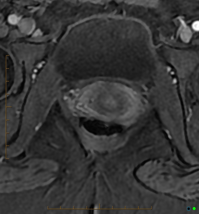 Adenomyosis uterus with hematometra (Radiopaedia 45779-50011 Axial T1 C+ fat sat 61).jpg