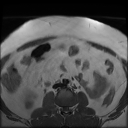 File:Adenomyosis within a didelphys uterus (Radiopaedia 70175-80215 Axial T1 2).jpg