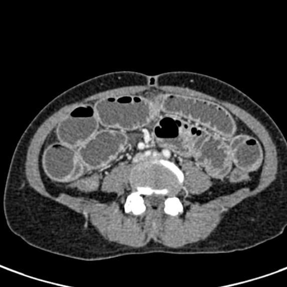 Adhesional small bowel obstruction (Radiopaedia 48397-53305 Axial C+ portal venous phase 54).jpg
