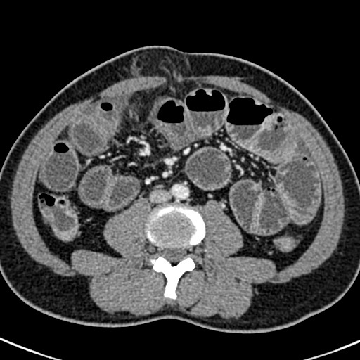 Adhesional small bowel obstruction (Radiopaedia 58900-66131 Axial C+ portal venous phase 29).jpg