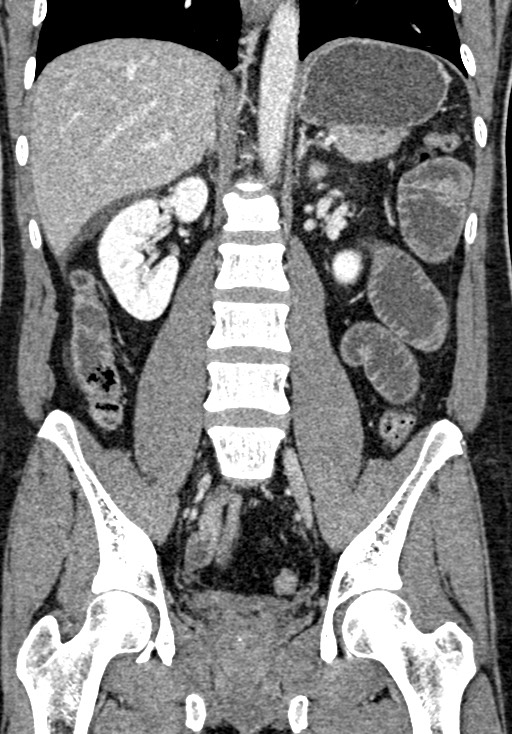Adhesional small bowel obstruction (Radiopaedia 58900-66131 Coronal C+ portal venous phase 160).jpg