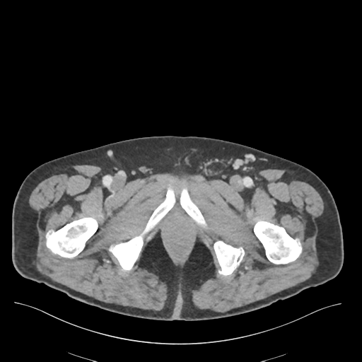 Adhesions within abdominal wall hernia (Radiopaedia 58283-65394 Axial C+ portal venous phase 88).png