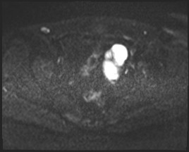 Adnexal multilocular cyst (O-RADS US 3- O-RADS MRI 3) (Radiopaedia 87426-103754 Axial DWI 44).jpg