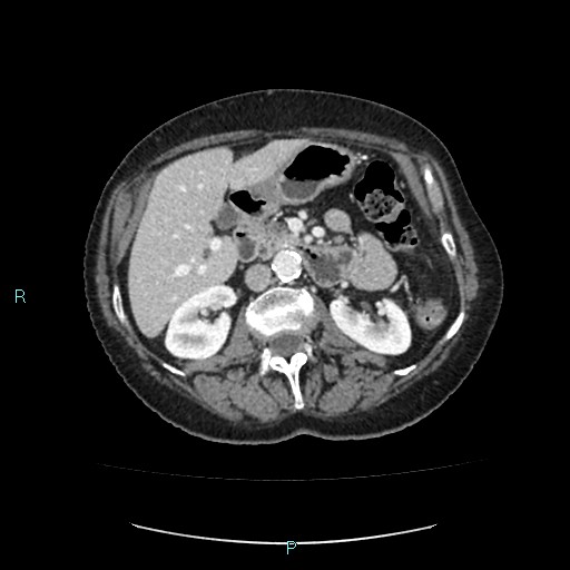 File:Adrenal collision tumor (ACT) (Radiopaedia 48462-53379 Axial C+ portal venous phase 23).jpg