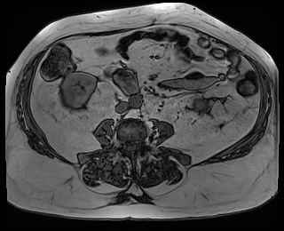File:Adrenal cortical carcinoma (Radiopaedia 64017-72770 Axial T1 out-of-phase 58).jpg