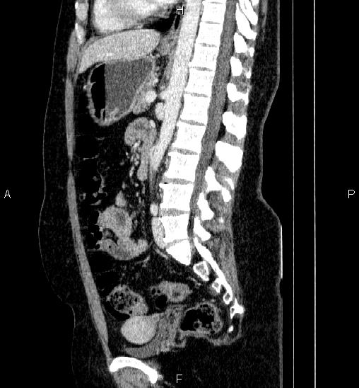 Adrenal cortical carcinoma (Radiopaedia 84882-100379 Sagittal C+ portal venous phase 50).jpg