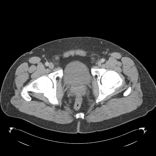 Adrenal cyst (Radiopaedia 45625-49776 Axial C+ portal venous phase 95).png