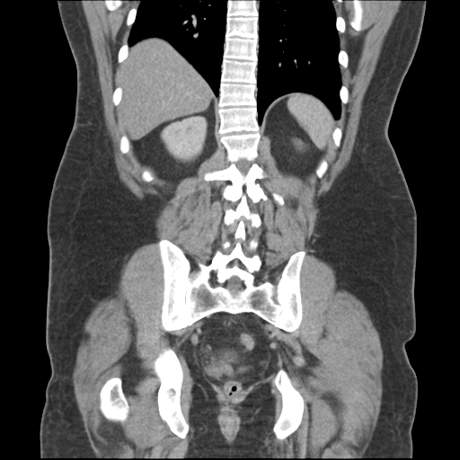 File:Adrenal cyst (Radiopaedia 45625-49776 Coronal C+ portal venous phase 54).png