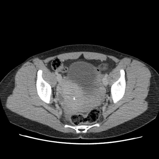 File:Adrenal cyst (Radiopaedia 64869-73813 Axial C+ portal venous phase 69).jpg