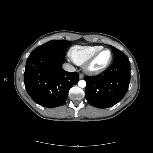 Adrenal cystic lymphangioma (Radiopaedia 83161-97534 Axial C+ arterial phase 8).jpg