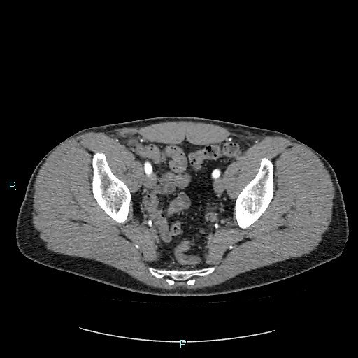 Adrenal cystic lymphangioma (Radiopaedia 83161-97534 Axial C+ arterial phase 85).jpg
