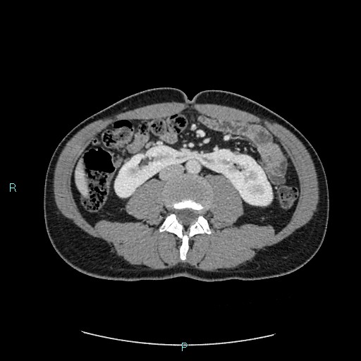 File:Adrenal cystic lymphangioma (Radiopaedia 83161-97534 Axial C+ portal venous phase 52).jpg