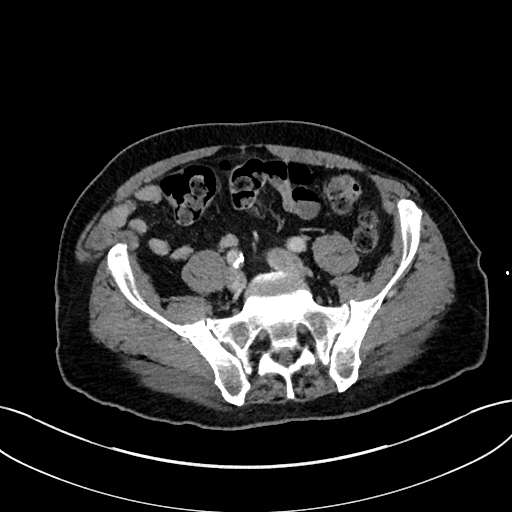 File:Adrenal lymphoma (Radiopaedia 73730-84529 Axial C+ portal venous phase 91).jpg