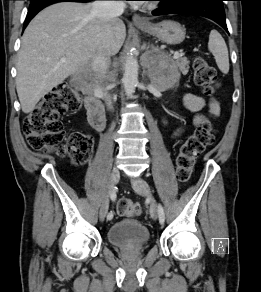 Adrenal lymphoma (Radiopaedia 73730-84529 Coronal C+ portal venous phase 43).jpg