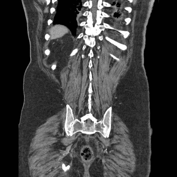 Adrenal lymphoma (Radiopaedia 84145-99415 Coronal C+ portal venous phase 76).jpg
