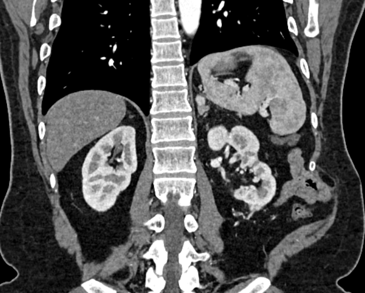 File:Adrenal metastases (Radiopaedia 73082-83791 Coronal C+ arterial phase 55).jpg