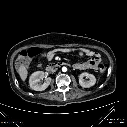 Adrenal metastasis (Radiopaedia 78425-91079 Axial C+ arterial phase 52).jpg