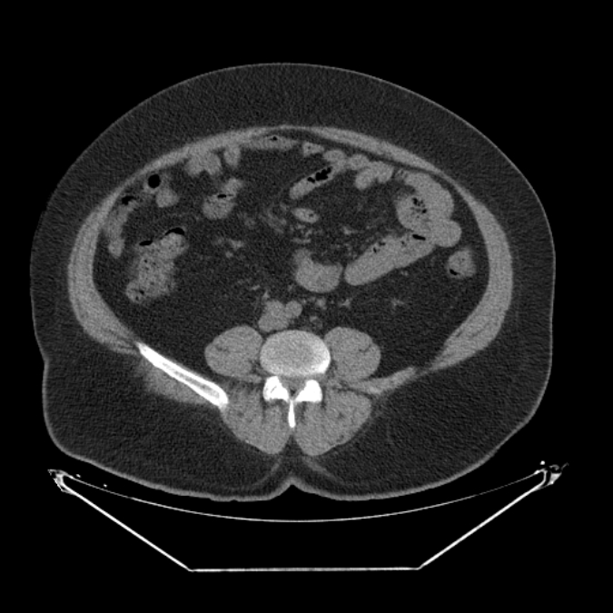 Adrenal myelolipoma (Radiopaedia 26278-26407 Axial non-contrast 44).jpg