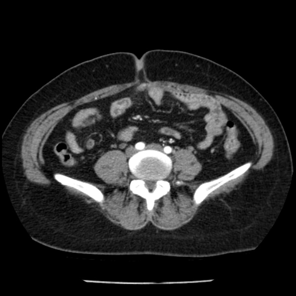 Adrenal myelolipoma (Radiopaedia 43401-46759 Axial C+ arterial phase 68).jpg