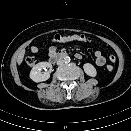 Adrenal myelolipoma (Radiopaedia 82742-96986 Axial renal excretory phase 76).jpg