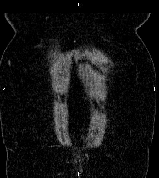 Adrenal myelolipoma (Radiopaedia 84319-99617 Coronal renal cortical phase 2).jpg