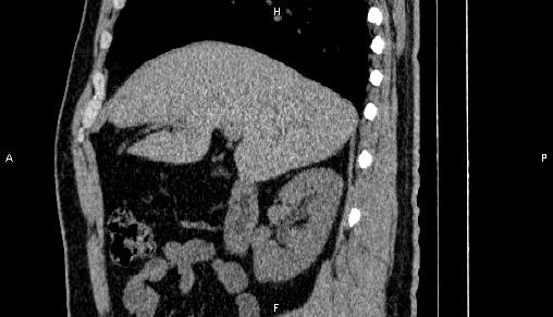 Adrenal myelolipoma (Radiopaedia 84321-99619 Sagittal non-contrast 35).jpg