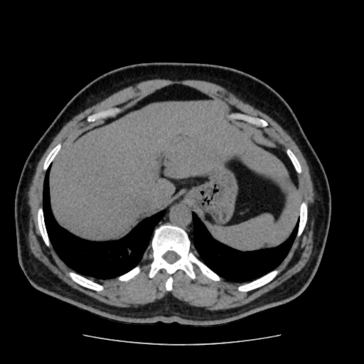 Adrenal myelolipoma and beaver tail liver (Radiopaedia 86201-102193 Axial non-contrast 75).jpg