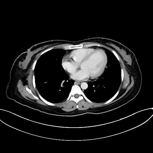 Adrenocortical carcinoma (Radiopaedia 87281-103569 Axial C+ portal venous phase 6).jpg