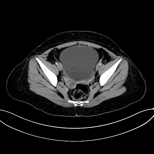 Adrenocortical carcinoma (Radiopaedia 87281-103569 Axial C+ portal venous phase 74).jpg
