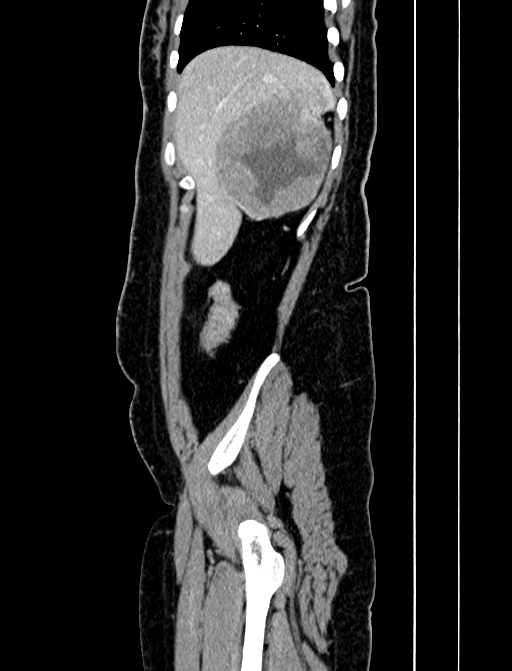Adrenocortical carcinoma (Radiopaedia 87281-103569 Sagittal C+ portal venous phase 34).jpg