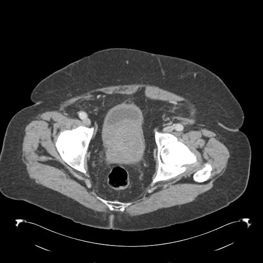 Adult ileal intussusception with secondary obstruction (Radiopaedia 30395-31051 Axial C+ portal venous phase 71).jpg