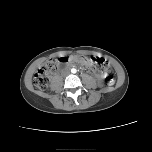 Adult polycystic kidney disease (Radiopaedia 48845-53876 Axial renal cortical phase 43).jpg