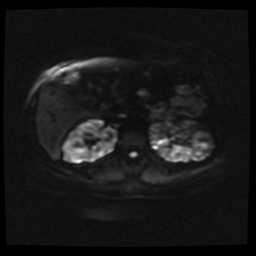 Adult polycystic kidney disease (Radiopaedia 59075-66365 Axial DWI 23).jpg